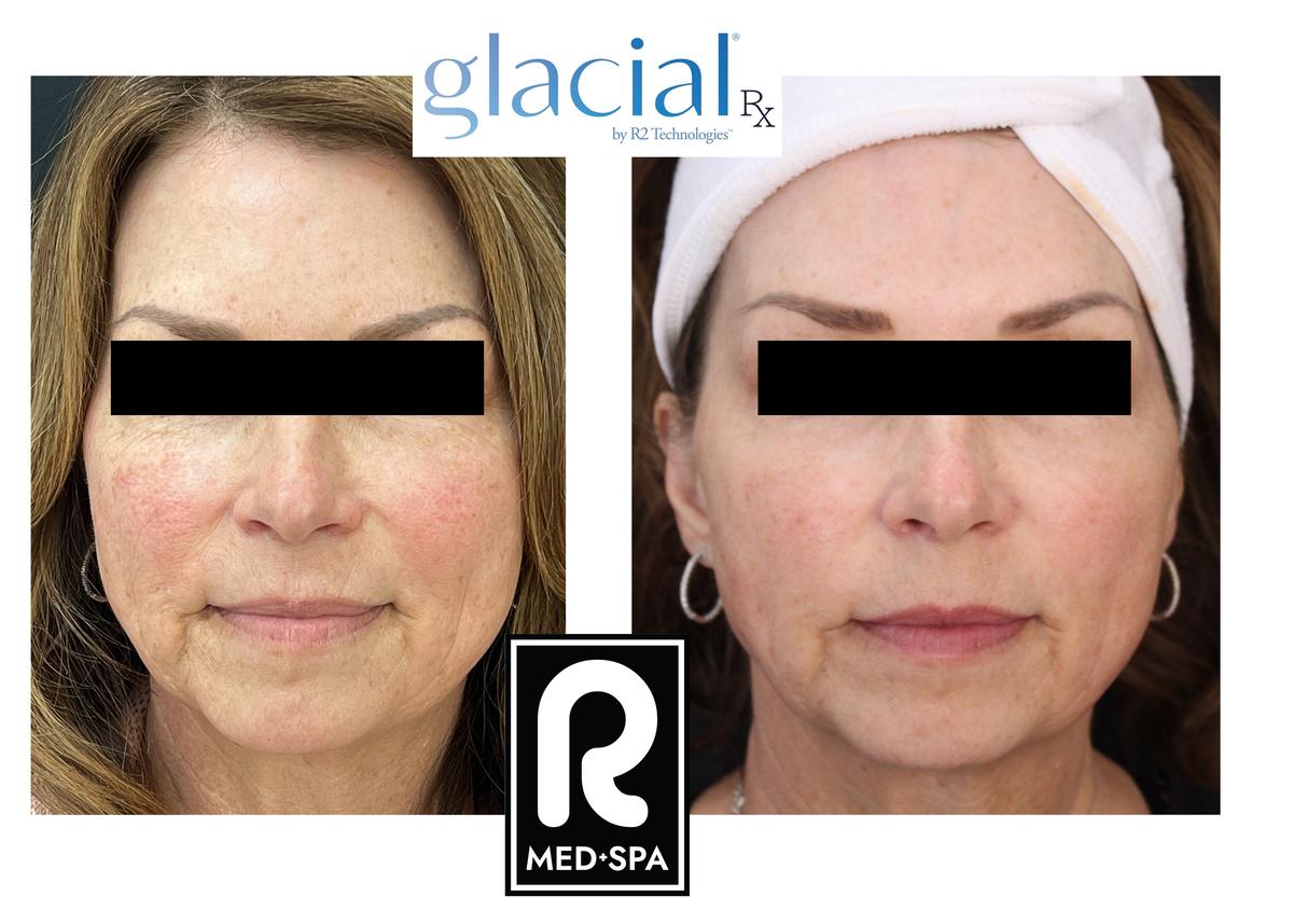 Clear Silk + Glacial® Rx Monthly