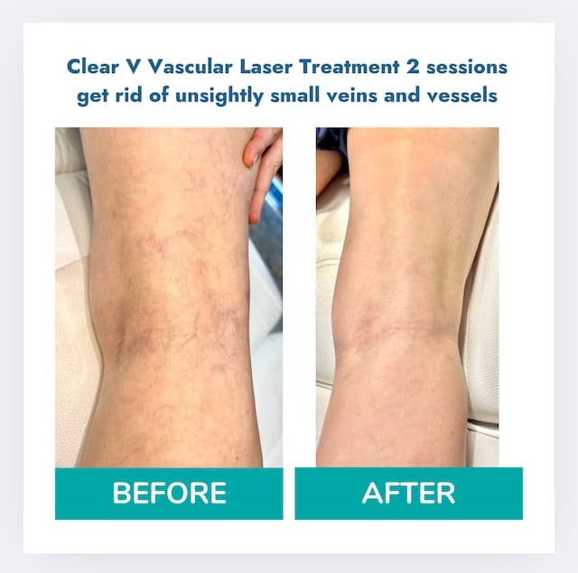 Clear V Vascular Laser