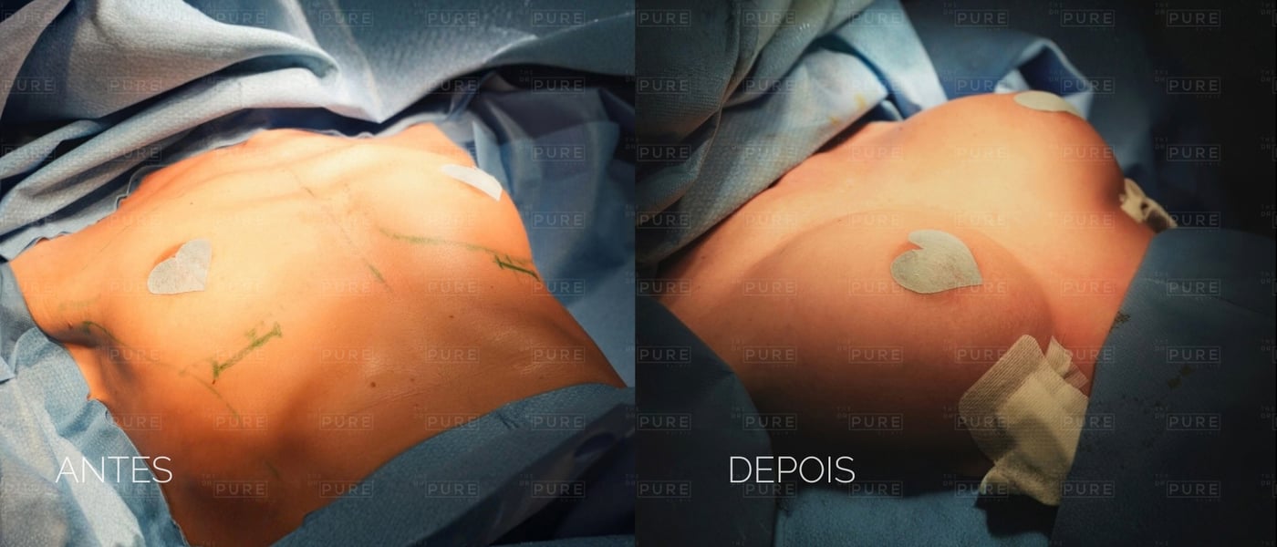 Imediatamente após — caso 3 — mamoplastia de aumento, antes e depois