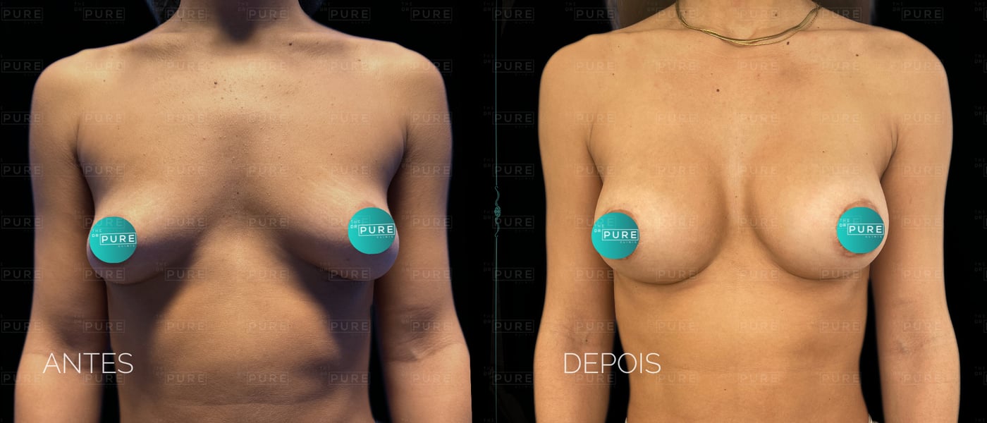 Caso 2 — vista frontal — mamoplastia de aumento, antes e depois