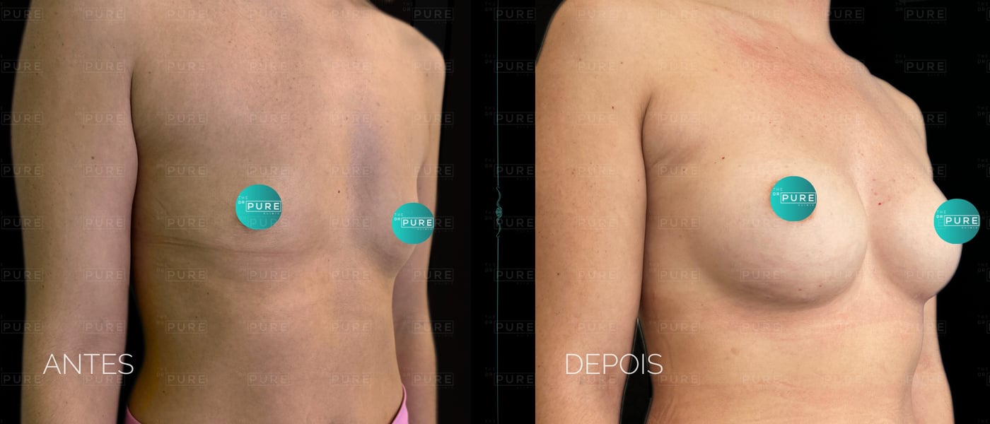 Caso 1 — vista de 3/4 — mamoplastia de aumento, antes e depois