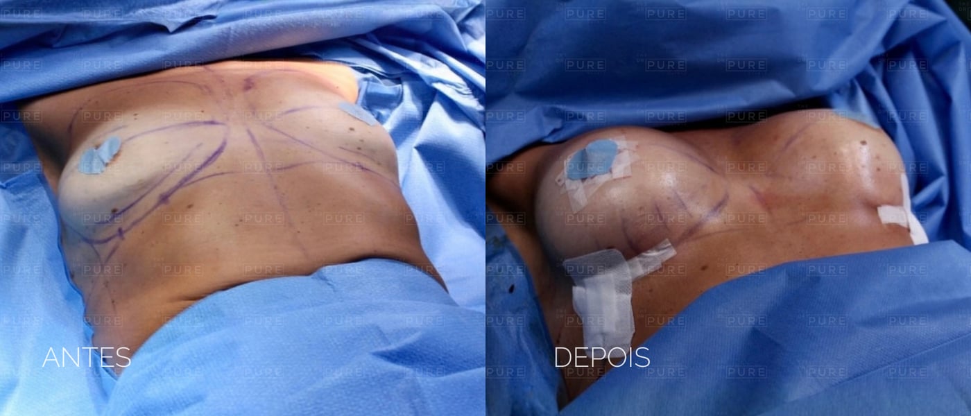 Imediatamente após — caso 2 — mamoplastia de aumento, antes e depois