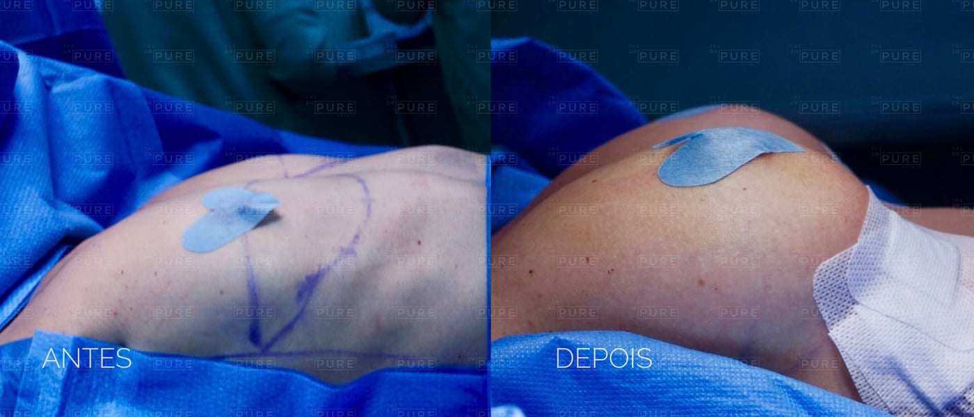 Imediatamente após — caso 1 — mamoplastia de aumento, antes e depois