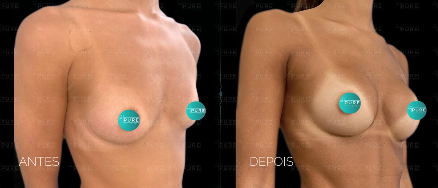 Caso 2 — vista de 3/4 — mamoplastia de aumento, antes e depois