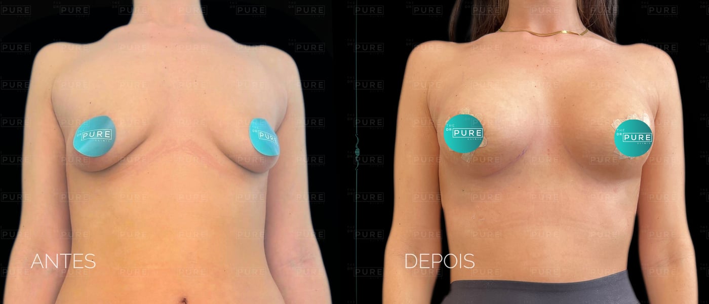 Caso 1 — vista frontal — mamoplastia de aumento, antes e depois
