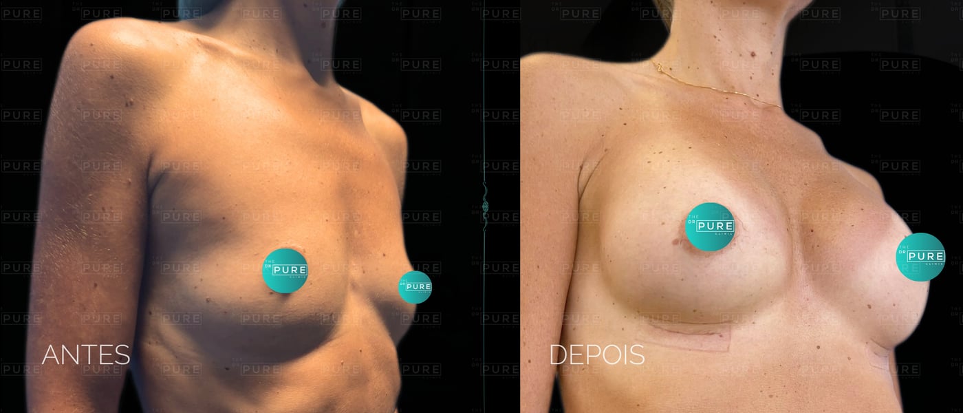Caso 3 — vista de perfil — mamoplastia de aumento, antes e depois