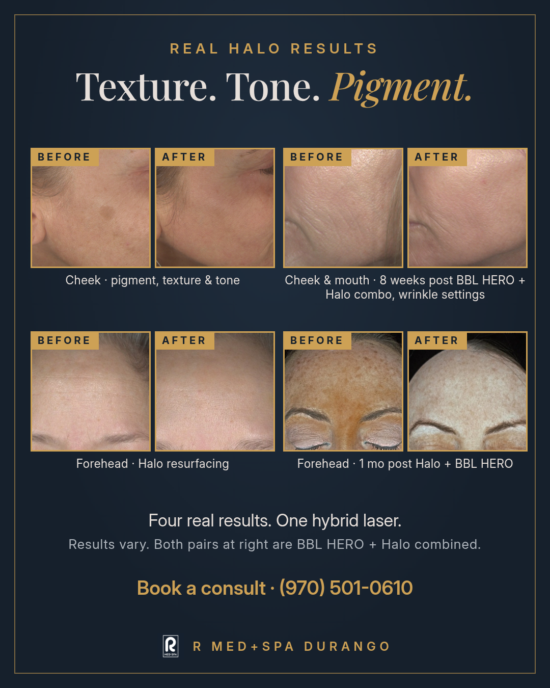 Real Halo results grid: before and after pairs showing cheek pigment, texture and tone, cheek and mouth wrinkles 8 weeks post BBL HERO + Halo combo, forehead Halo resurfacing, and forehead 1 month post Halo + BBL HERO at R Med+Spa Durango