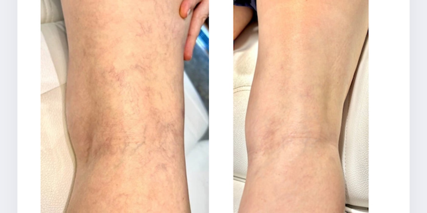 Clear V Vascular Laser