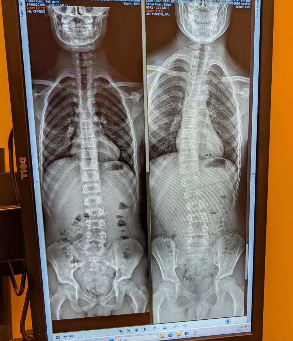 Postural correction case study results