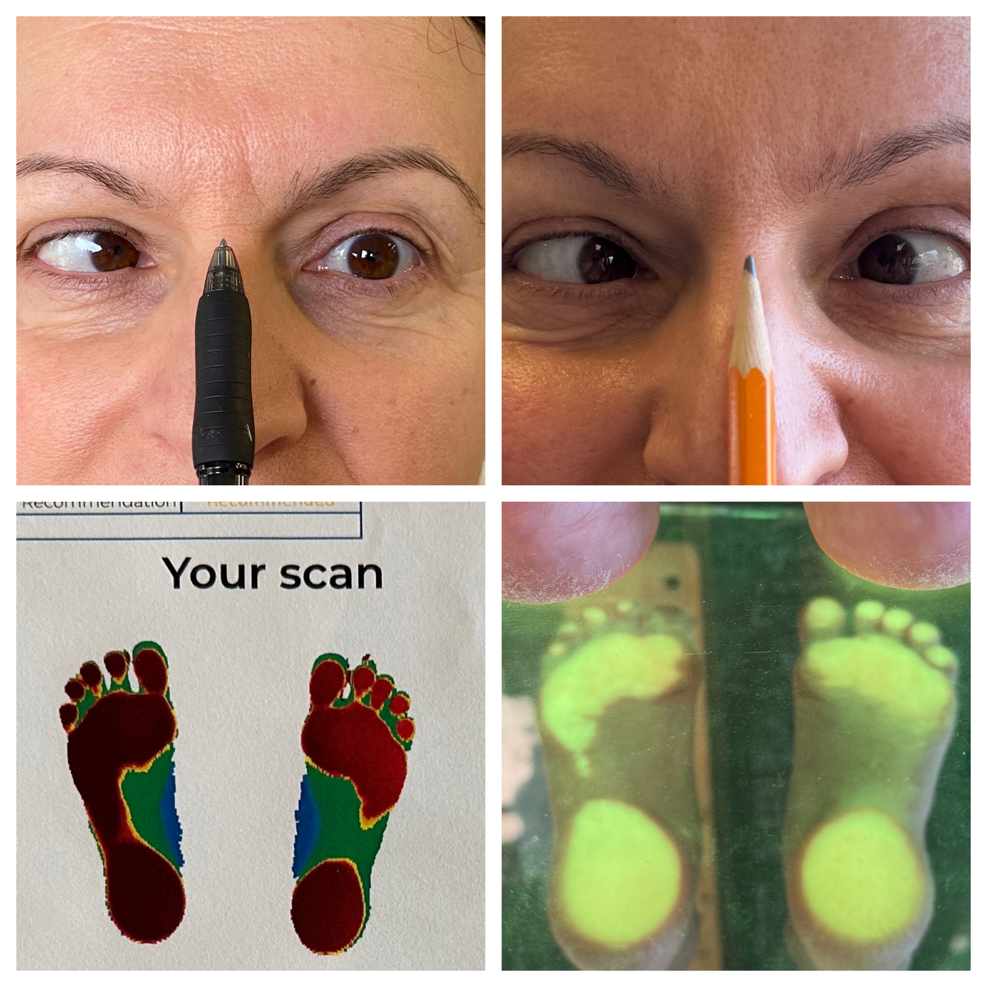 Postural assessment case showing balance and alignment changes