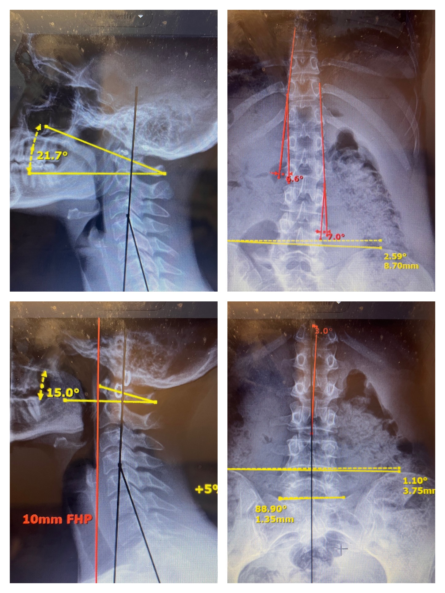 Pre and post X-ray comparison showing cervical spine alignment improvements