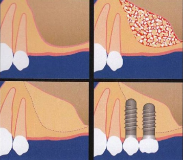 Zubní implantáty – ilustrace postup zavedení