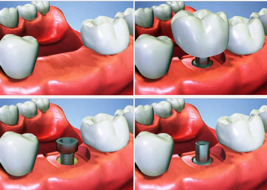 Postup zavedení zubního implantátu – ilustrace