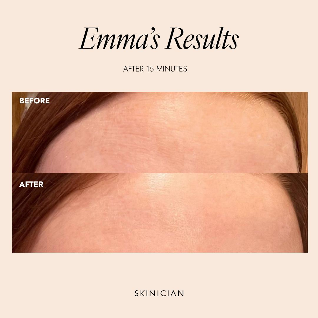 Emma's results after Skinician Peptide treatment — forehead lines smoothed and skin plumped after 15 minutes