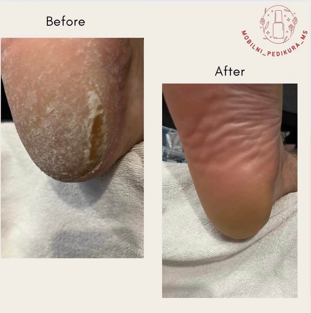 Před a po pedikúře - ukázka výsledků