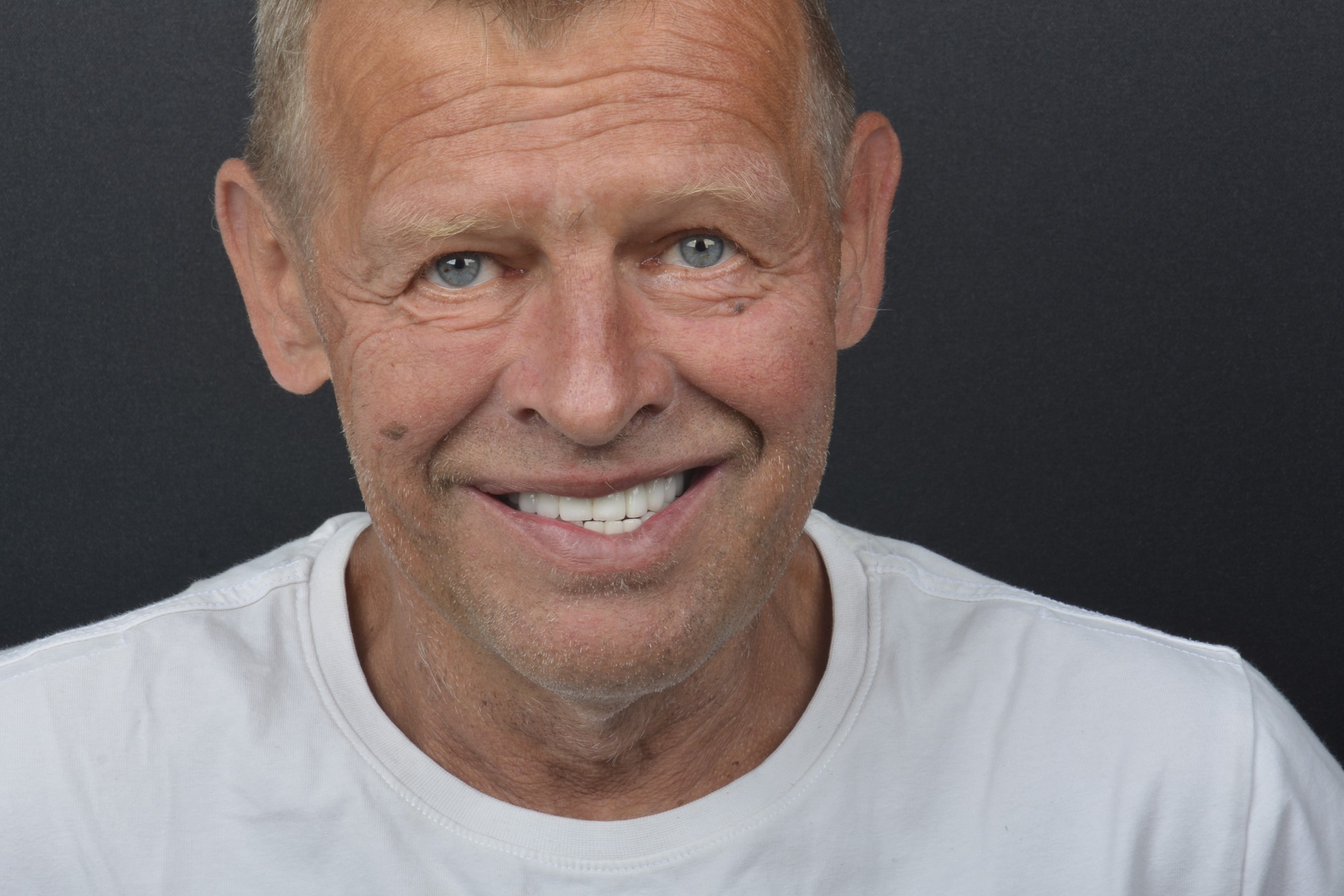 Josef Víns – po zákroku (foto 1)