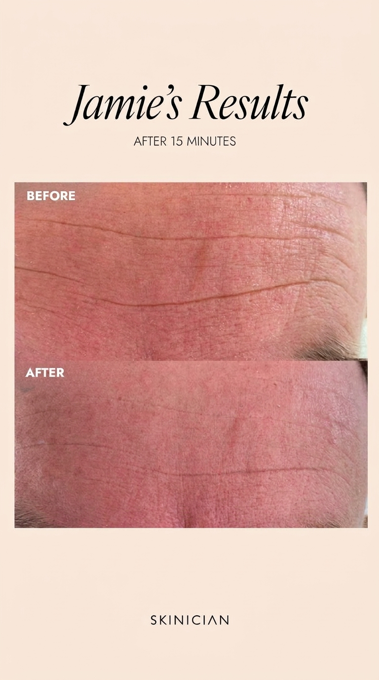 Jamie's results after Skinician Peptide treatment — forehead lines visibly reduced after 15 minutes