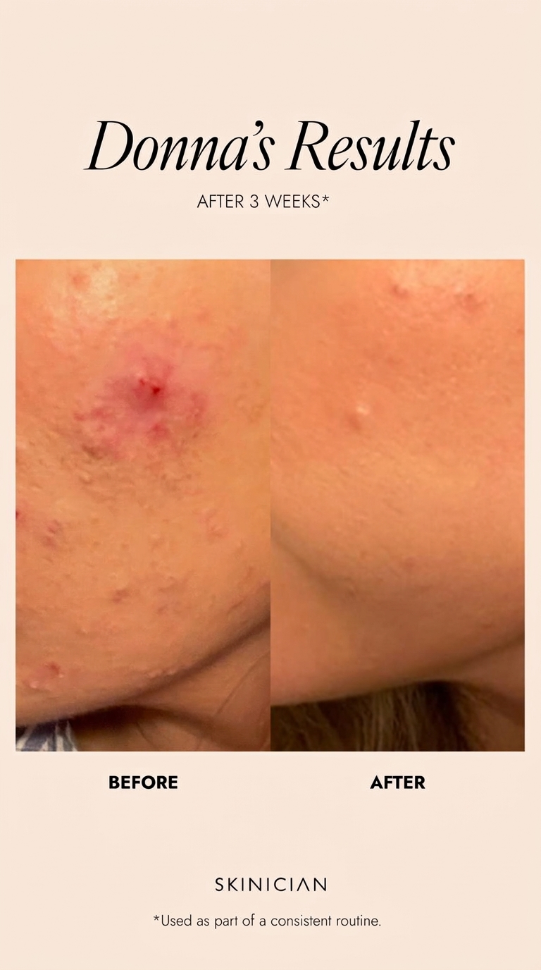 Donna's results after using Skinician Pro Retinol Balm — breakouts and acne dramatically reduced after 3 weeks