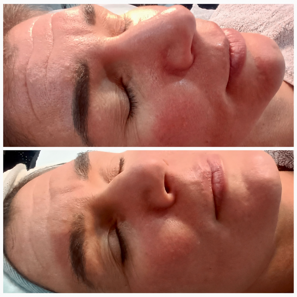 Opatra facial before and after results